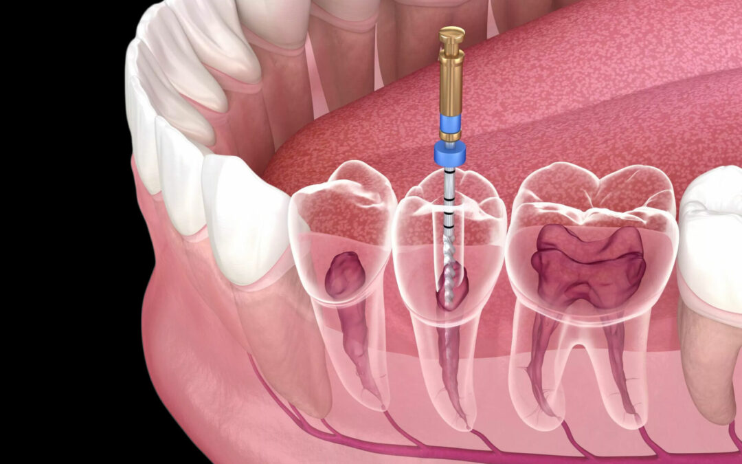 “Demystifying Root Canal Treatment: 5 Astonishing Facts That Separate Fact from Fiction”
