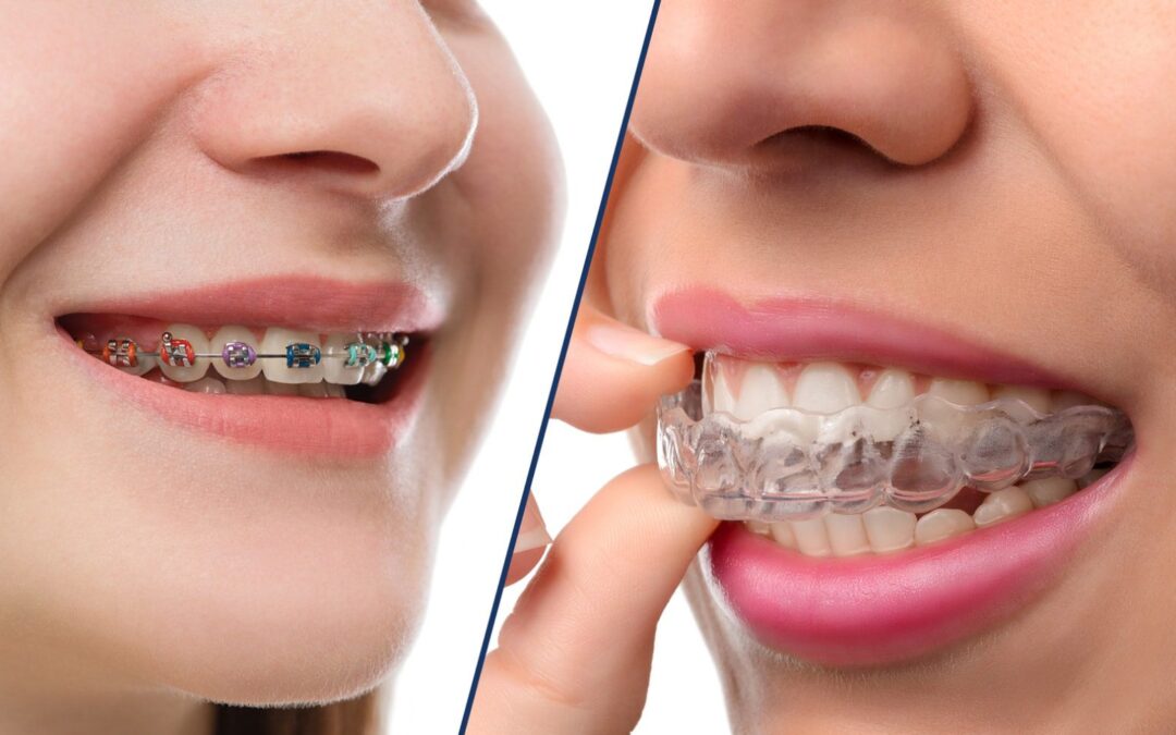 “5 Key Differences Between Invisalign and Traditional Braces: The Ultimate Guide to Choose the Right Treatment at i-Smile Dental Clinic”