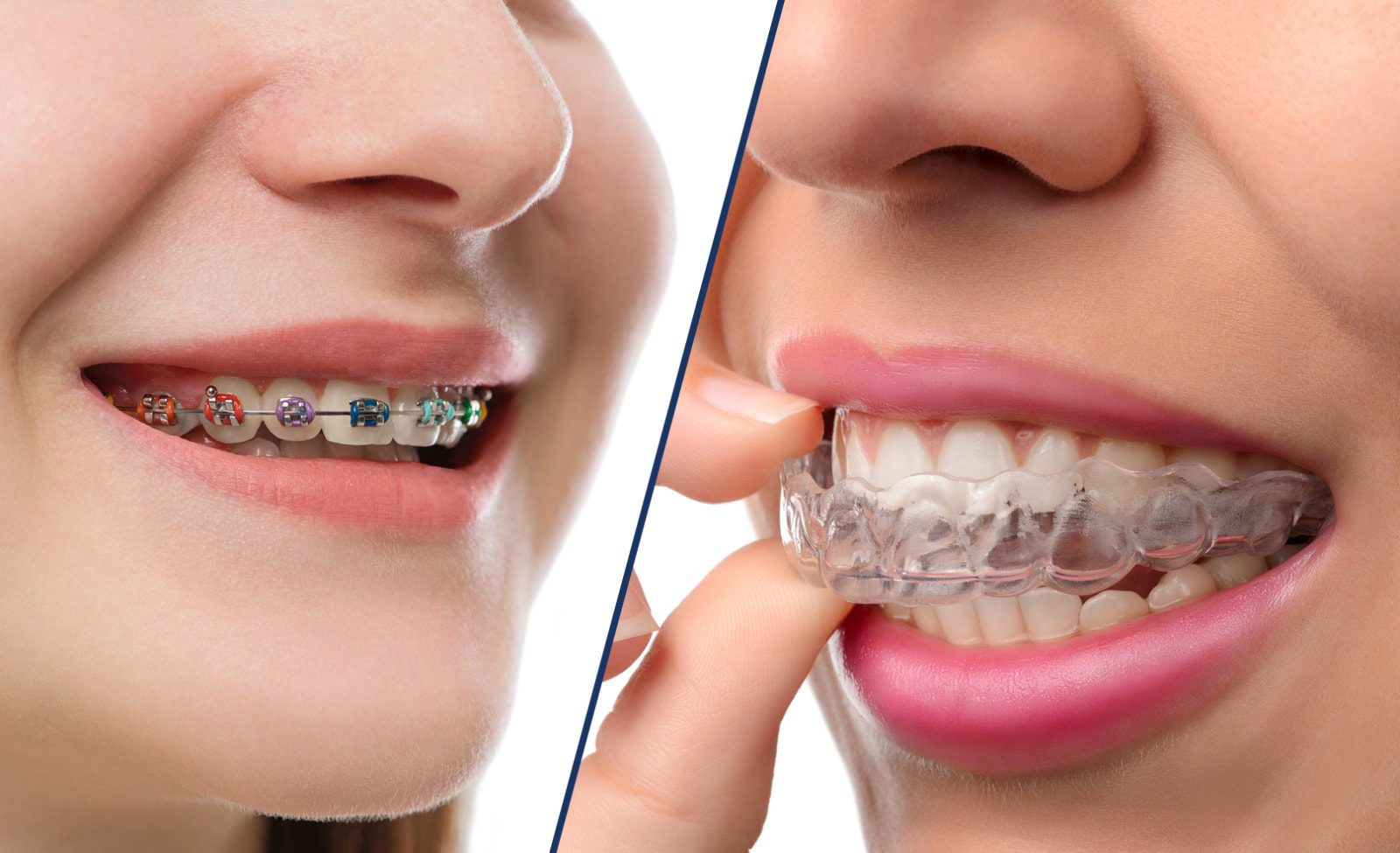 Invisalign or Dental Braces